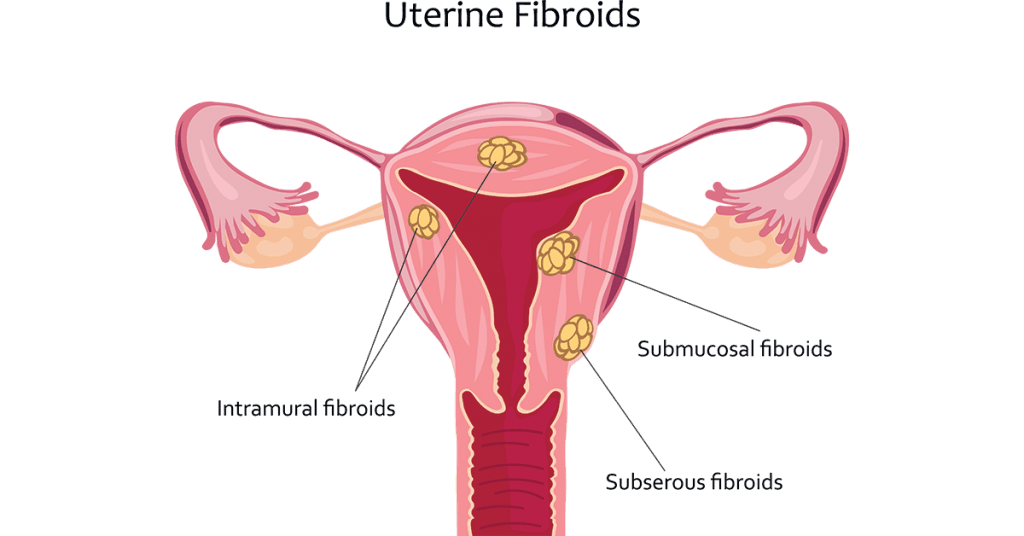 Preferred-Vascular Uterine-Fibroids-1024x536